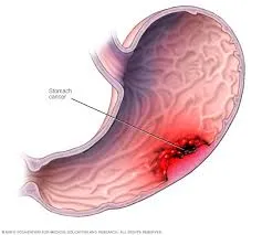 Gastric cancer image 1