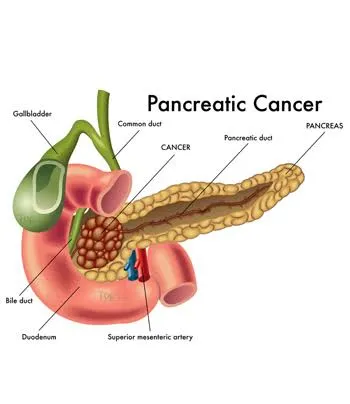 Hepatobiliary and pancreatic cancers image 1
