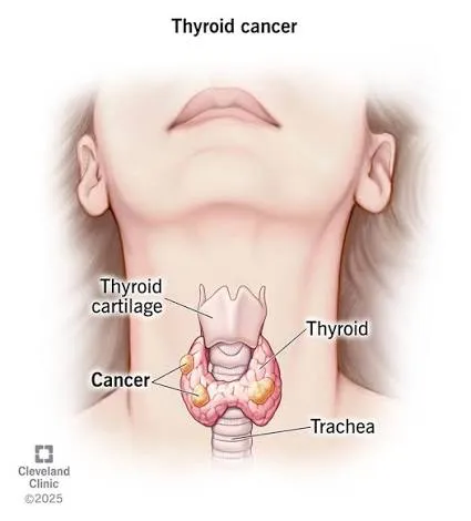 Thyroid cancers image 1