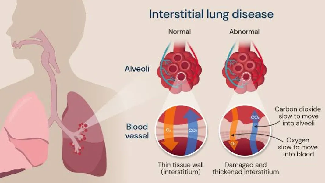 Interstitial Lung Disease (ILD) image 1