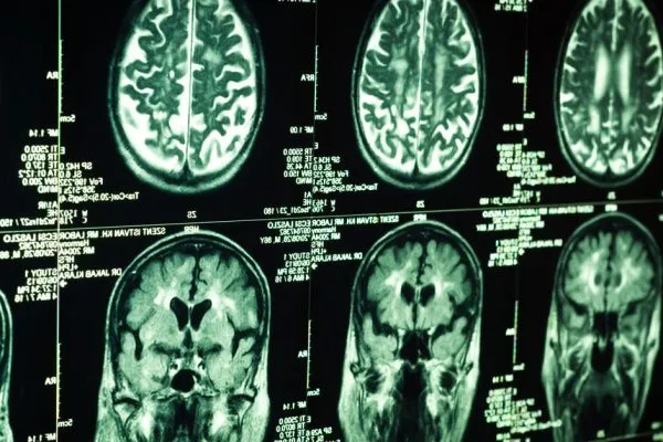 Traumatic Brain Injury image 2