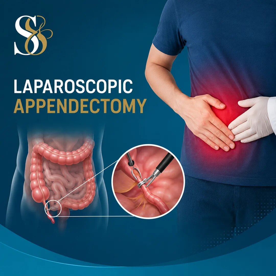 Laparoscopic Appendectomy image 1