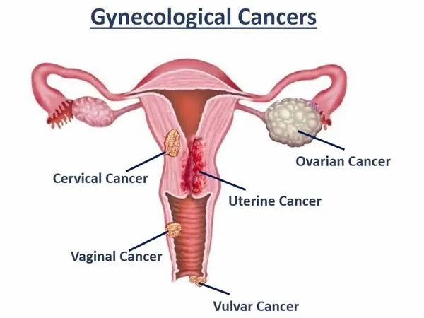 Gynaecological cancer (Ovarian, Endometrial, Cervix) image 1