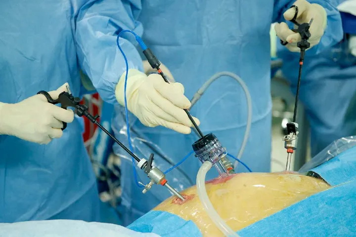 Laparoscopic cancer surgery image 1