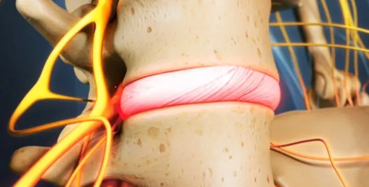 Degenerative Disc Disease image 1