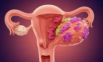 Ovarian Cyst Treatment image 1