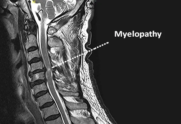 Cervical Myelopathy image 1
