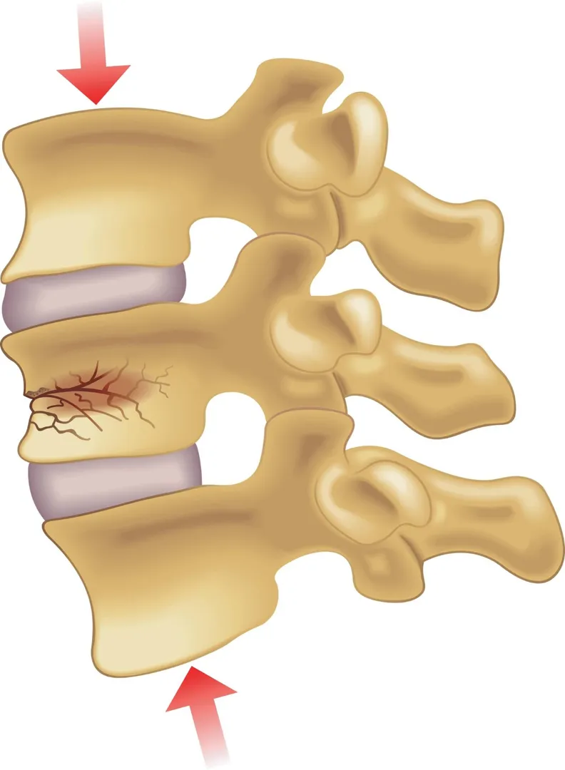 Spine Fracture image 1