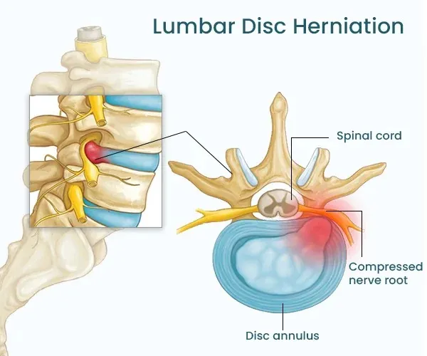 Lumbar Slip Disc image 1