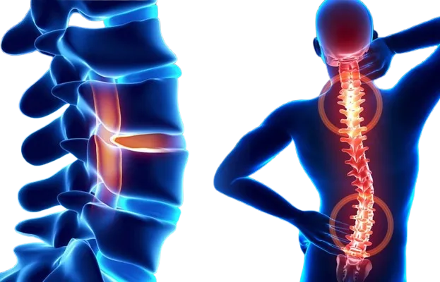 Spinal Deformity Correction image 1