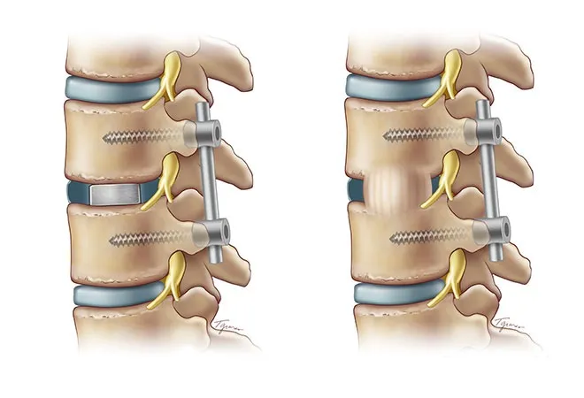 Lumbar (MIS-TLIF) image 1