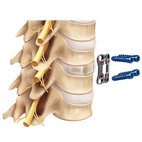 Anterior Cervical Discectomy & Fusion image 1