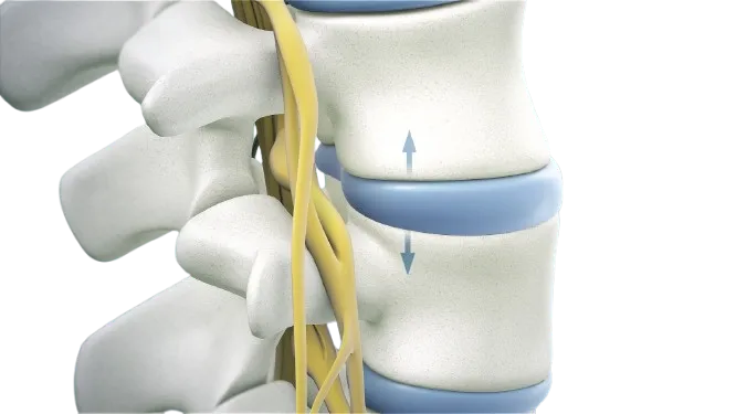 Spinal Decompression Surgery image 1