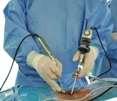 Laser Endoscopic Discectomy image 1