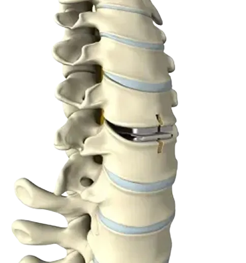 Cervical Disc Replacement image 1