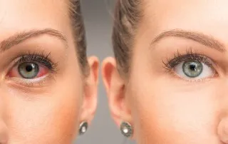 Glaucoma image 1