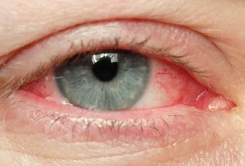 Dry Eye image 1