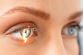 LASIK image 1