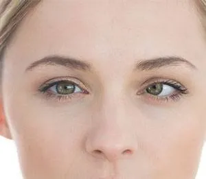Amblyopia image 1