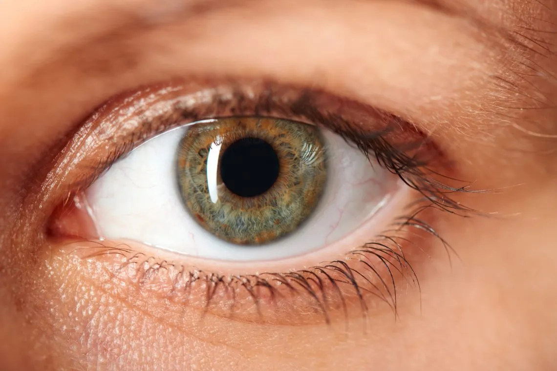 Cataract  image 1