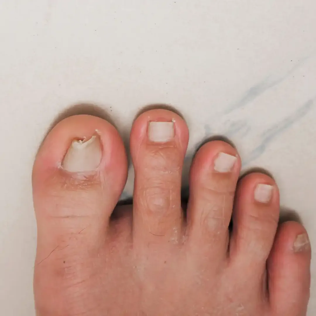 Ingrown Toe Nail - Partial Toe Nail Avulsion image 1