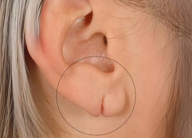 Ear Lobe Repair image 1