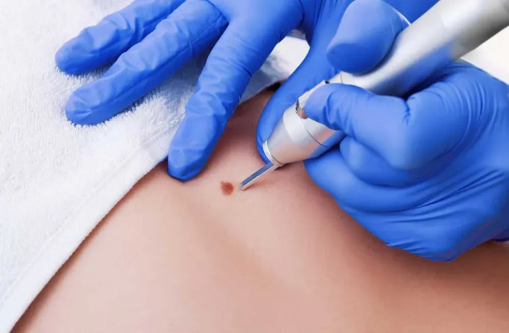 Corn-Wart-Skin Tag Removal image 1