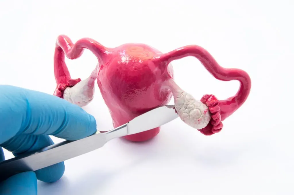 Cystectomy Procedure image 1