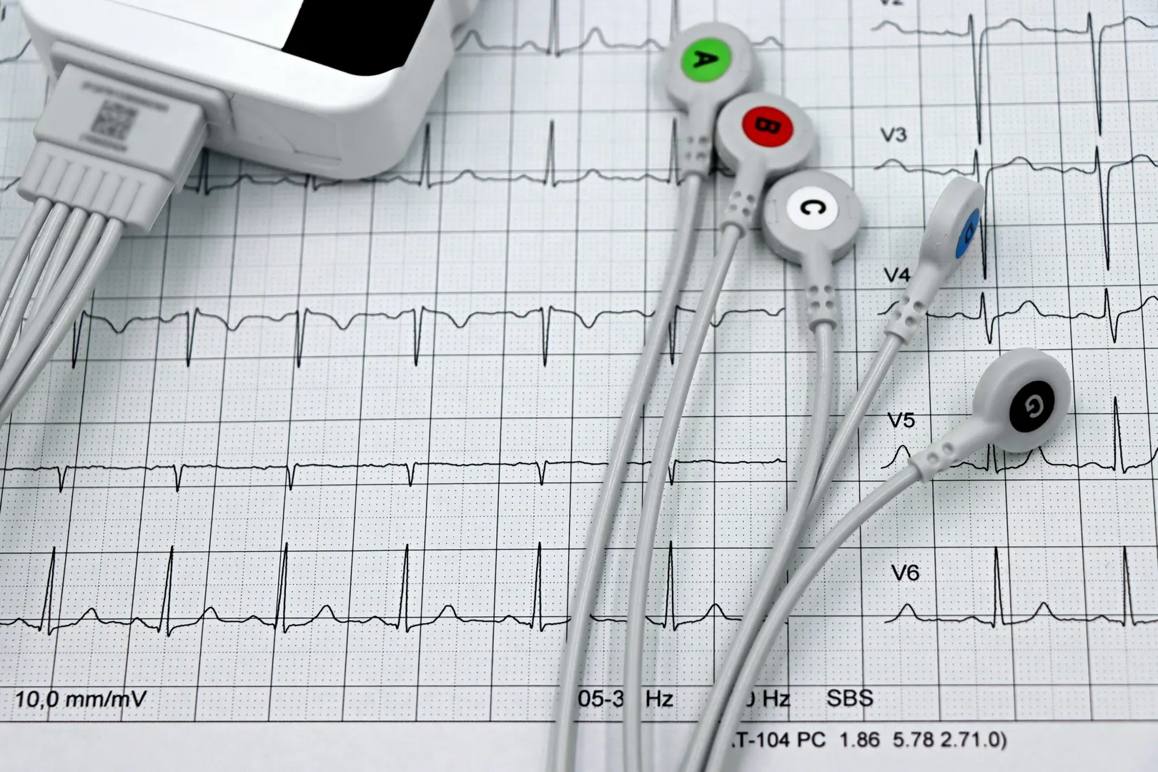 ECG (Electrocardiogram) image 1