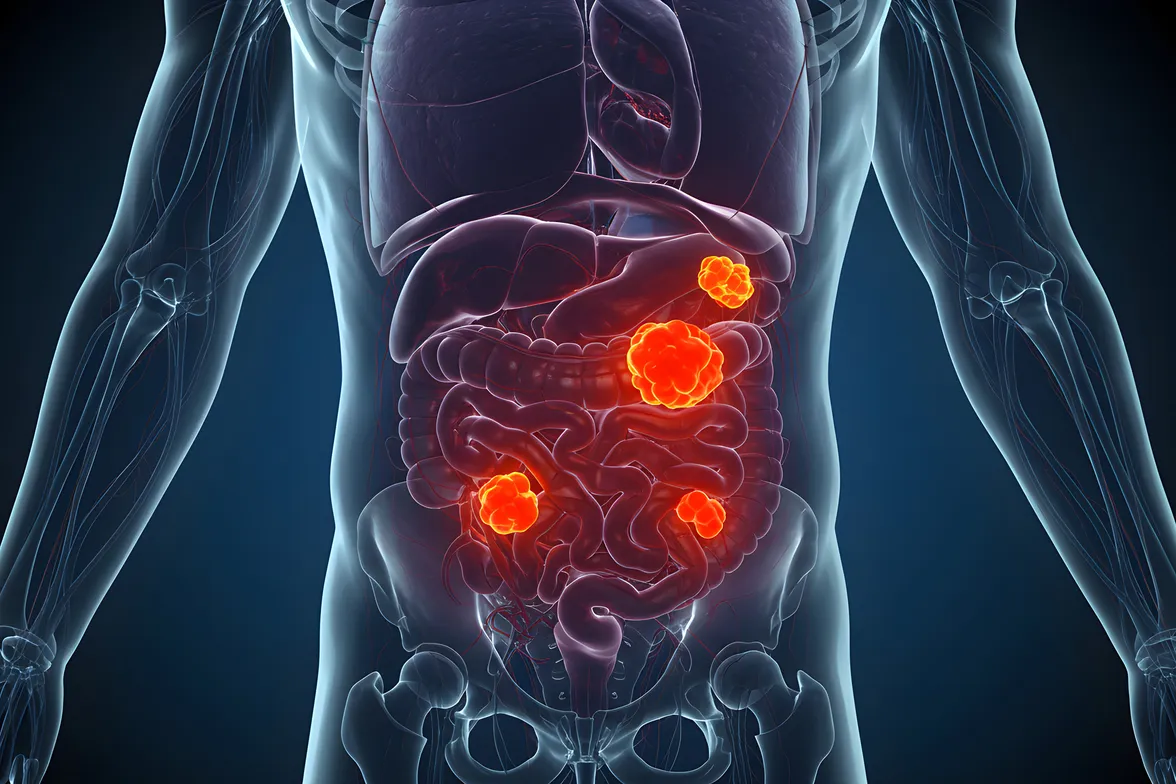 Peritoneal Surface Malignancies image 1