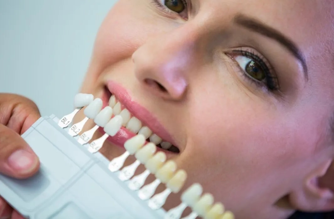 Dental Veneers (E.max Veneers)  image 1