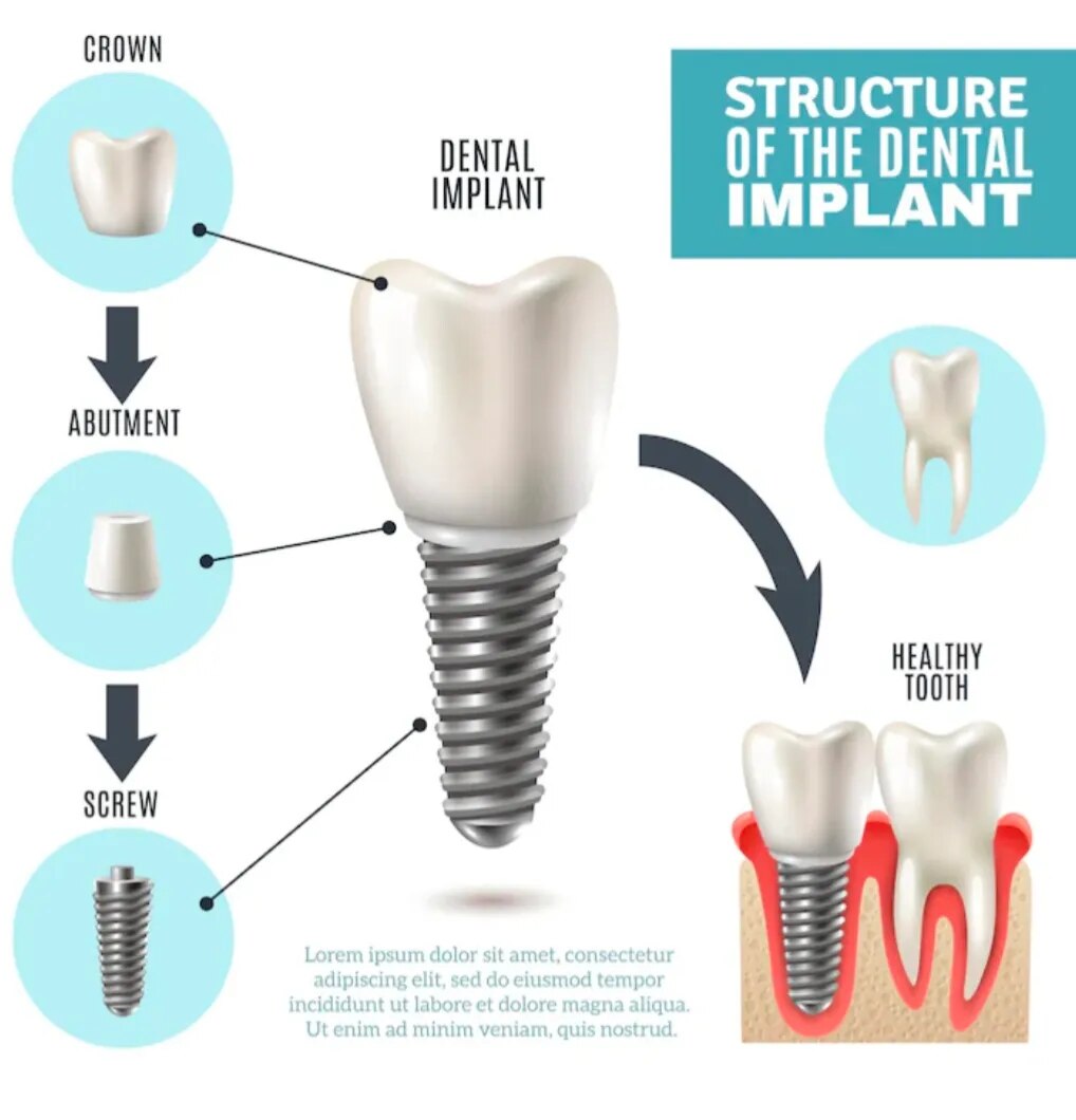 Dental Implants image 1