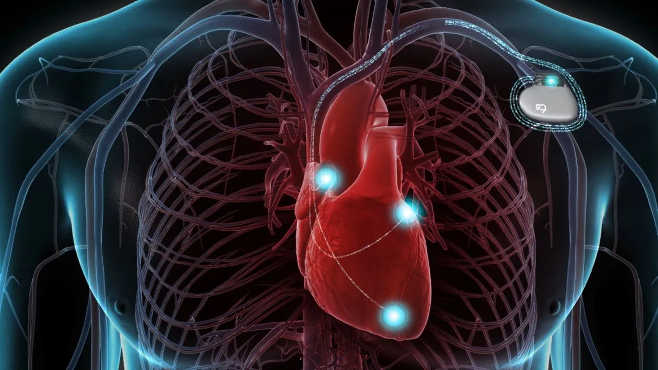 ICD Implantation  image 1