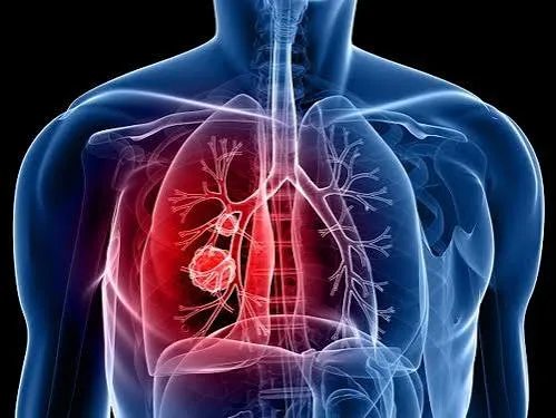 Thoracic Malignancies image 1