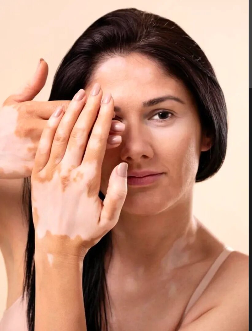 Vitiligo (Leukoderma)Treatment in Nashik image 1