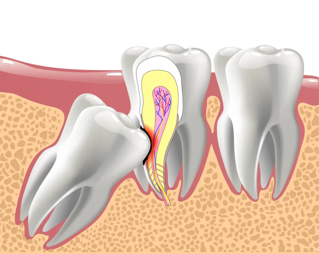 Impaction   image 1