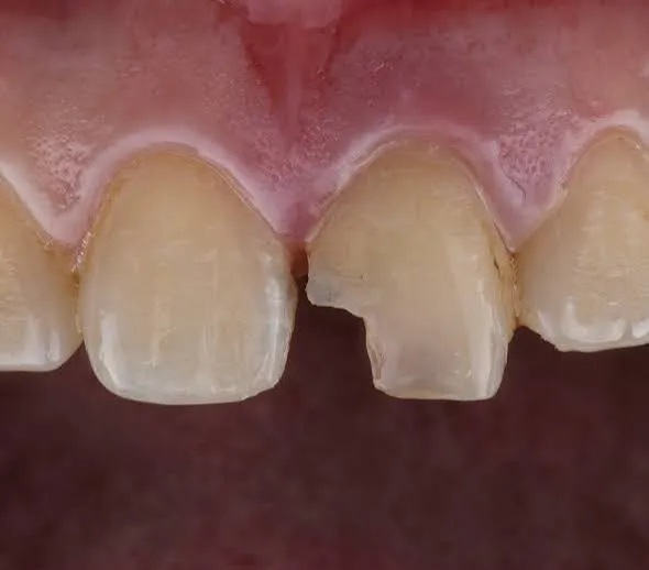 Broken or Chipped Tooth Consultation image 1