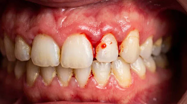 Bleeding Gums Treatment  image 1