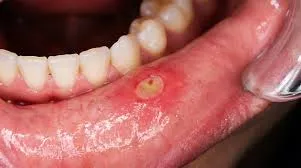 Mouth Ulcer Consultation image 1