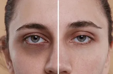 Dark Circle Removal image 1