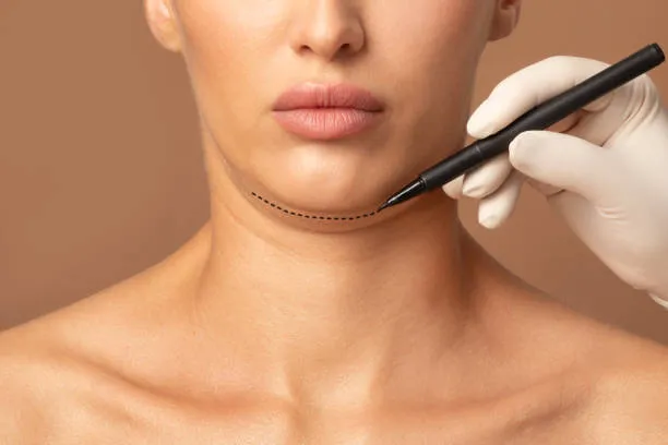 Double Chin Removal image 1