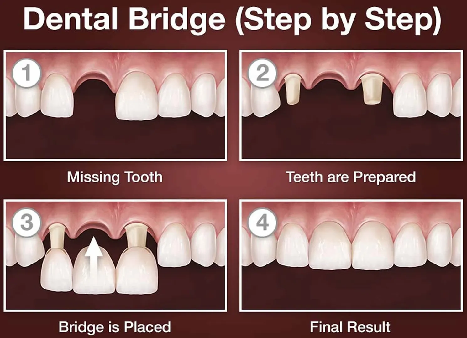 Removable and fixed teeth crown / bridge image 1