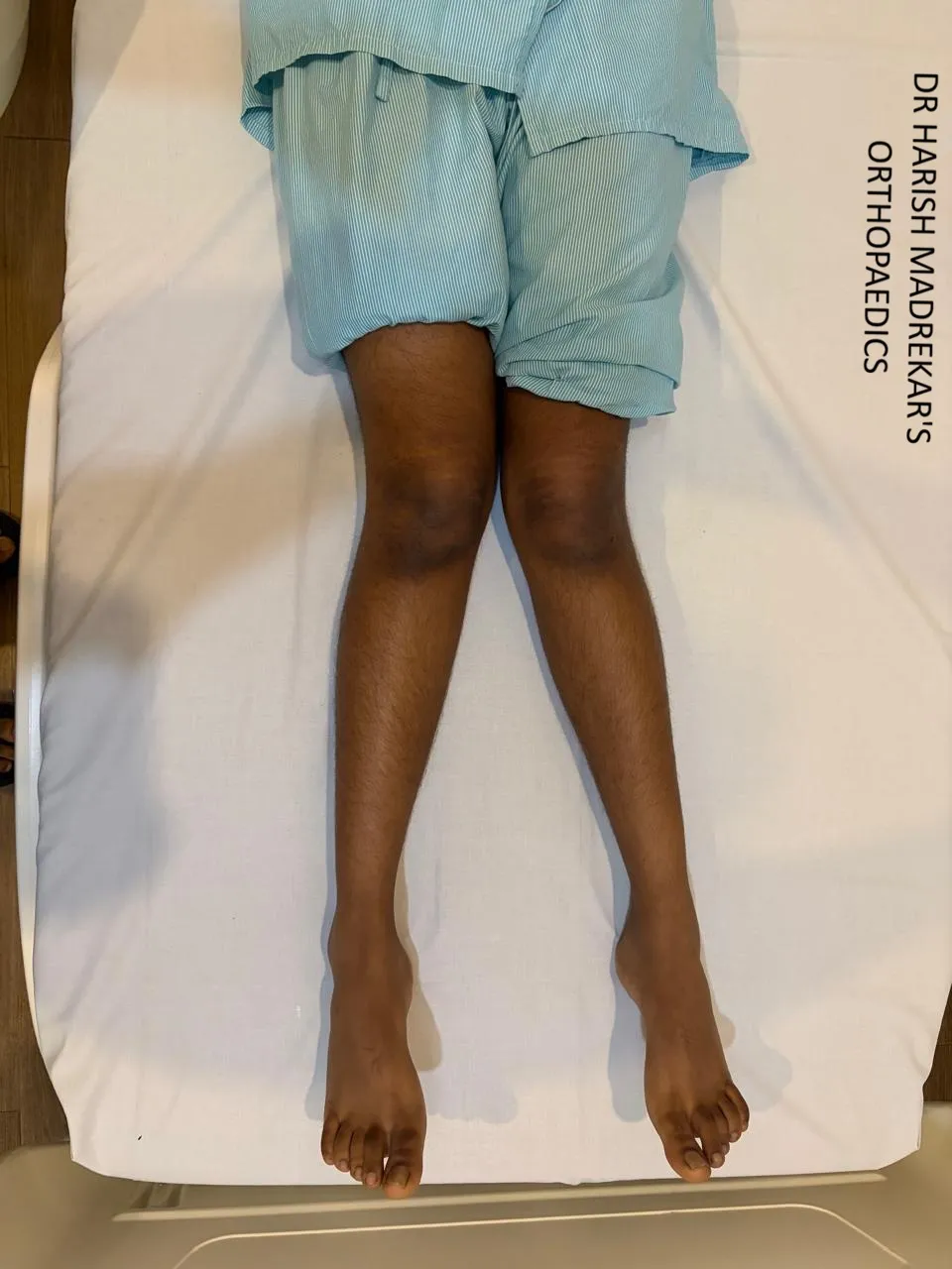 KNEE DEFORMITY CORRECTION IN CHILDREN image 1