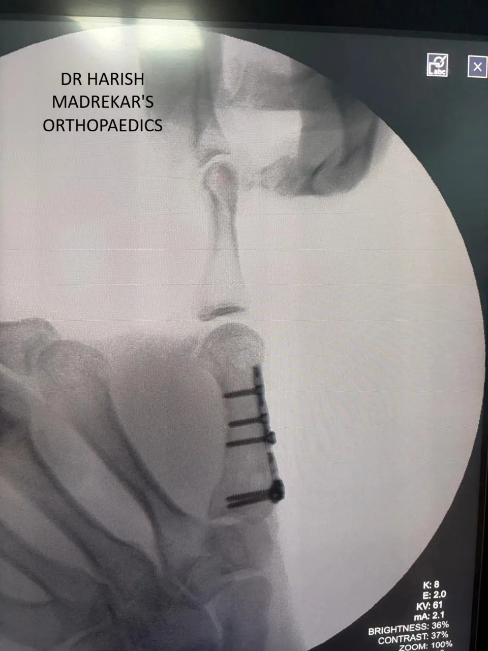 Rolando Fractur -intra-articular fracture at the base of the first metacarpal  image 1