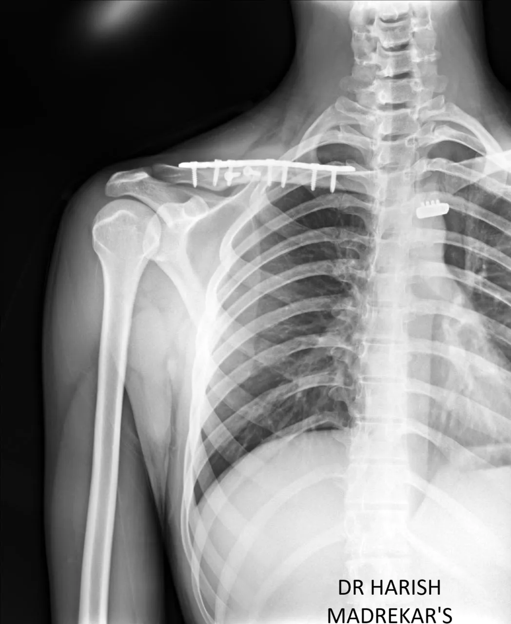 CLAVICLE FRACTURE  image 1