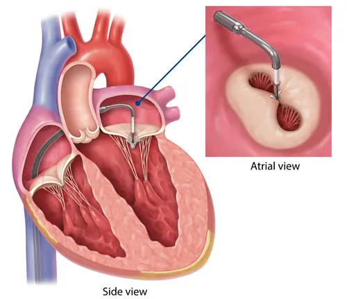Mitraclip Procedures image 1