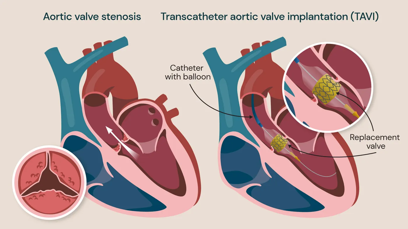 TAVI / TAVR Procedure  image 1