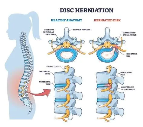 Slip Disc / Herniated Disc image 1