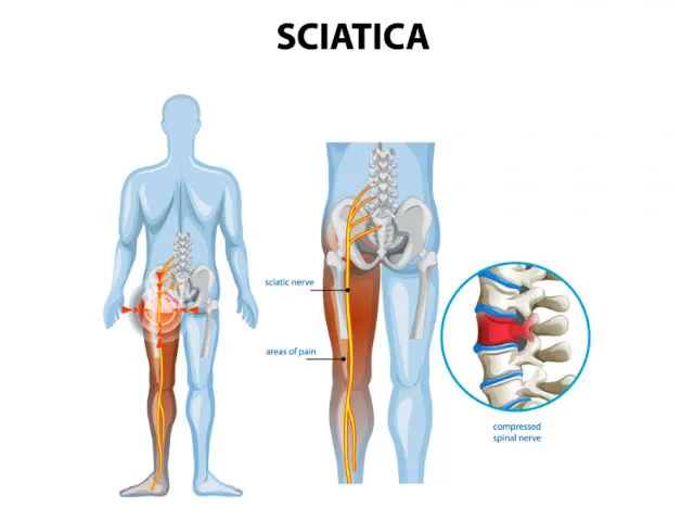 Sciatica image 1