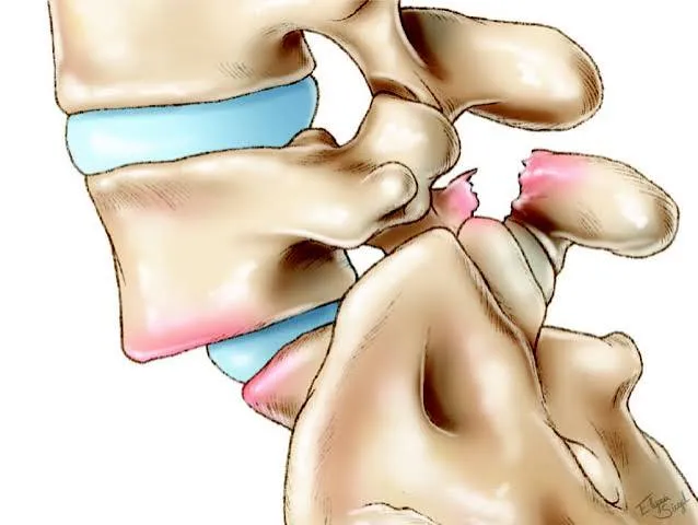 Spondylolisthesis image 1